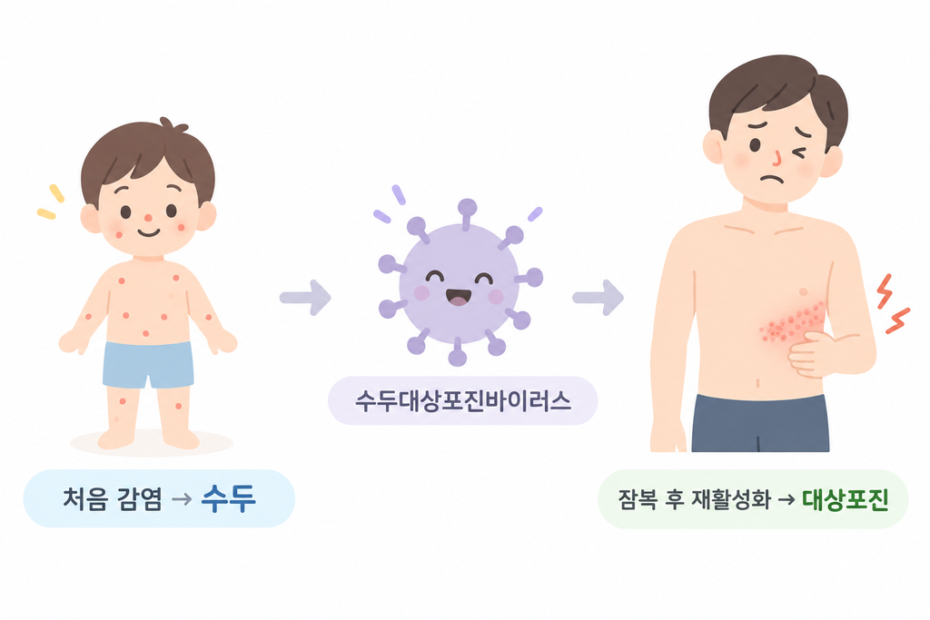 수두에서 대상포진으로 이어지는 과정